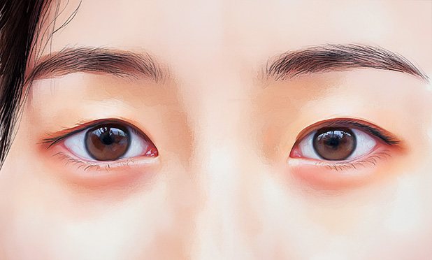 케이스 2 Before — 두 눈(풀린 라인)