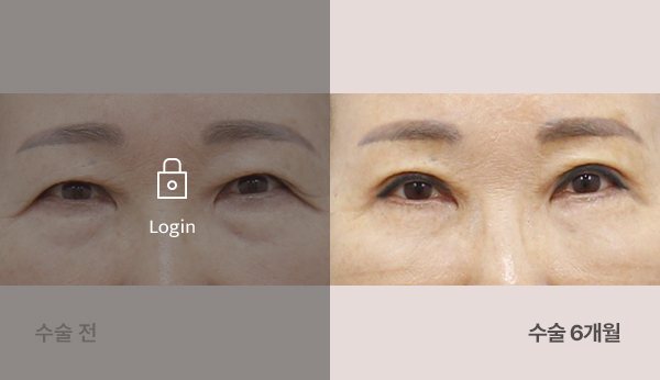 엔도타인내시경이마거상+상안검재수술눈매교정+하안검재배치외안각고정 전후사진 — 눈, 왼쪽 수술 전(어둡게·자물쇠 Login) / 오른쪽 수술 6개월