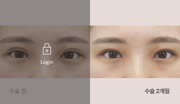 라인낮추기 절개 재수술 눈매교정+앞, 위트임 전후사진 — 눈, 왼쪽 수술 전(어둡게·자물쇠 Login) / 오른쪽 수술 2개월