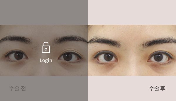 절개쌍꺼풀재수술눈매교정+앞, 위트임 전후사진 — 눈, 왼쪽 수술 전(어둡게·자물쇠 Login) / 오른쪽 수술 후