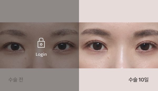 매몰눈재수술눈매교정 전후사진 — 눈, 왼쪽 수술 전(어둡게·자물쇠 Login) / 오른쪽 수술 10일