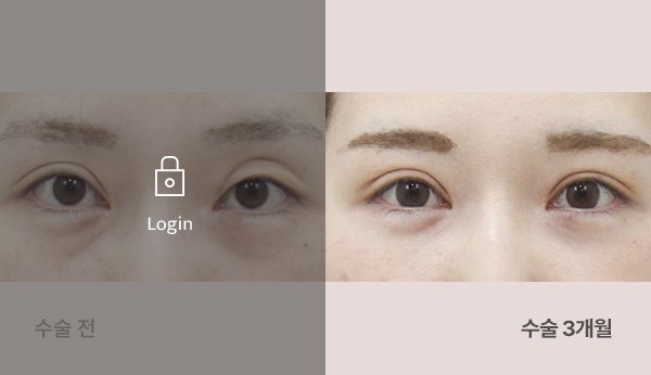눈재수술 전후사진 — 눈, 왼쪽 수술 전(어둡게·자물쇠 Login) / 오른쪽 수술 3개월