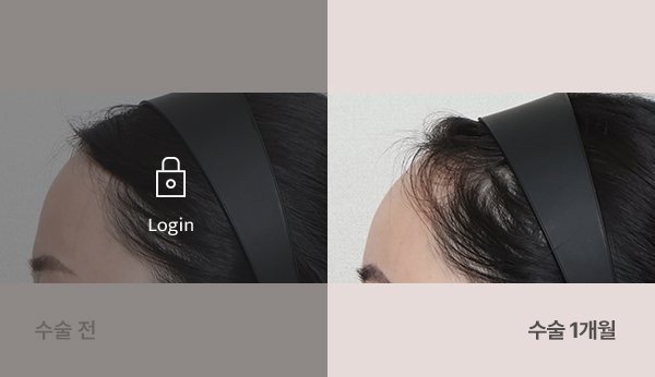 이마지방이식재수술 전후사진 — 이마 옆모습, 왼쪽 수술 전(어둡게·자물쇠 Login) / 오른쪽 수술 1개월