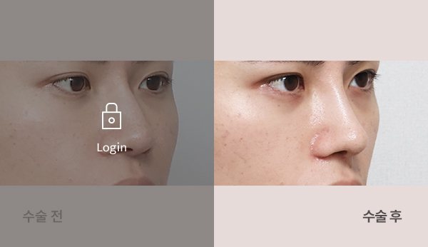 매부리코코성형술+콧대코끝이물질제거 전후사진 — 코 45도, 왼쪽 수술 전(어둡게·자물쇠 Login) / 오른쪽 수술 후