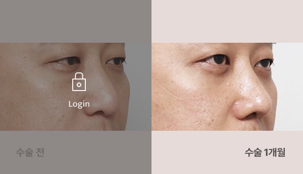 무보형물코끝성형술 전후사진 — 코 45도, 왼쪽 수술 전(어둡게·자물쇠 Login) / 오른쪽 수술 1개월