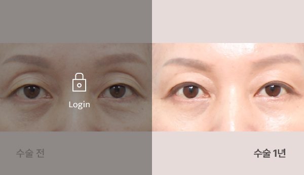상안검눈매교정+눈두덩이지방이식 전후사진 — 눈, 왼쪽 수술 전(어둡게·자물쇠 Login) / 오른쪽 수술 1년