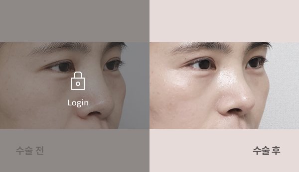 무보형물코끝성형술 전후사진 — 코 45도, 왼쪽 수술 전(어둡게·자물쇠 Login) / 오른쪽 수술 후