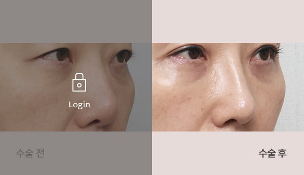 개방형코재수술 전후사진 — 코 45도, 왼쪽 수술 전(어둡게·자물쇠 Login) / 오른쪽 수술 후