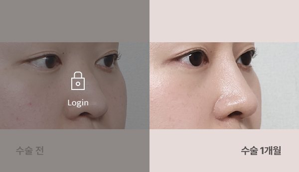 미니자가늑 매부리코 코성형술 전후사진 — 코 45도, 왼쪽 수술 전(어둡게·자물쇠 Login) / 오른쪽 수술 1개월