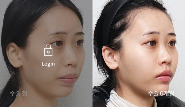 턱 실리콘 보형물 전후사진 — 얼굴 45도, 왼쪽 수술 전(어둡게·자물쇠 Login) / 오른쪽 수술 6개월