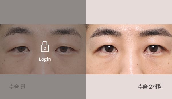 절개무쌍눈매교정 전후사진 — 눈(남성), 왼쪽 수술 전(어둡게·자물쇠 Login) / 오른쪽 수술 2개월