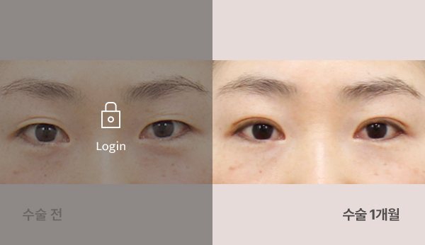 매몰쌍꺼풀 전후사진 — 눈, 왼쪽 수술 전(어둡게·자물쇠 Login) / 오른쪽 수술 1개월