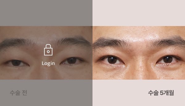 남자절개눈매교정 전후사진 — 눈(남성), 왼쪽 수술 전(어둡게·자물쇠 Login) / 오른쪽 수술 5개월