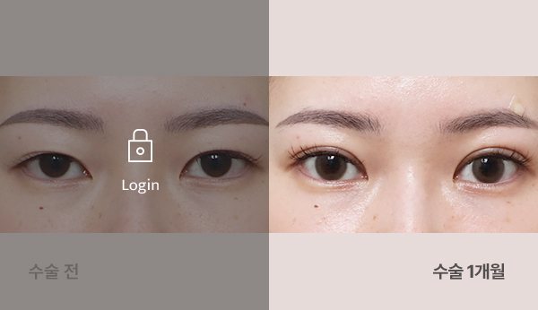 매몰쌍꺼풀 전후사진 — 눈, 왼쪽 수술 전(어둡게·자물쇠 Login) / 오른쪽 수술 1개월