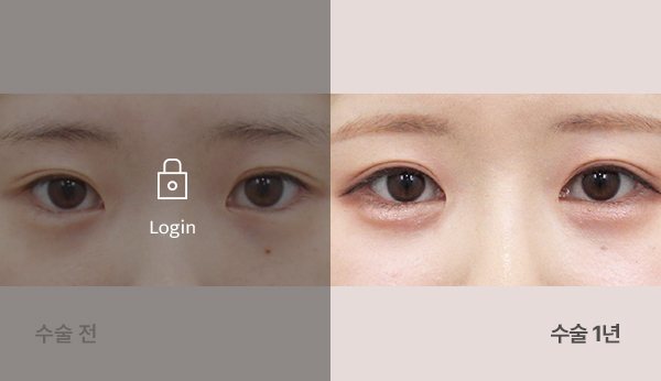 앞트임+뒤,밑트임 전후사진 — 눈, 왼쪽 수술 전(어둡게·자물쇠 Login) / 오른쪽 수술 1년