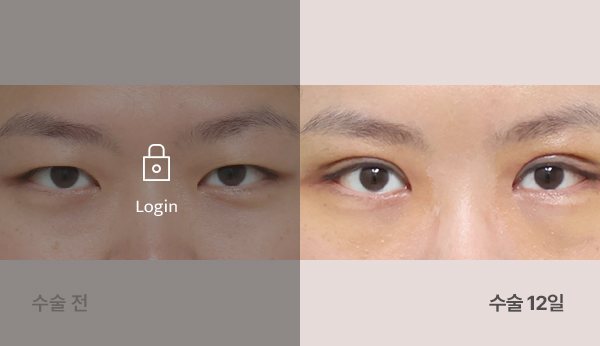 절개쌍꺼풀눈매교정+엔도타인내시경이마거상술 전후사진 — 눈, 왼쪽 수술 전(어둡게·자물쇠 Login) / 오른쪽 수술 12일