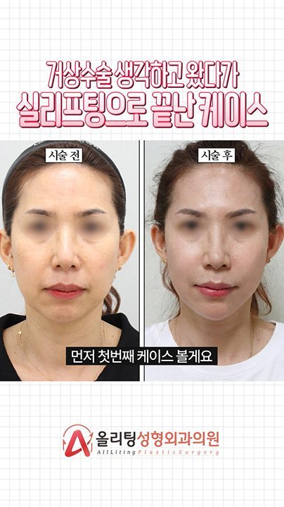 거상수술 생각하고 왔다가 실리프팅으로 끝난 케이스 시술 전 · 시술 후 먼저 첫번째 케이스 볼게요 올리팅성형외과의원