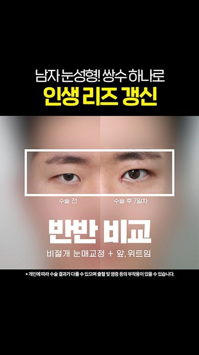 남자 눈성형! 쌍수 하나로 인생 리즈 갱신 수술 전 · 수술 후 7일차 반반 비교 비절개 눈매교정 + 앞, 위트임 * 개인에 따라 수술 결과가 다를 수 있으며 출혈 및 염증 등의 부작용이 있을 수 있습니다.