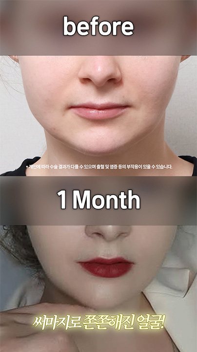 before * 개인에 따라 수술 결과가 다를 수 있으며 출혈 및 염증 등의 부작용이 있을 수 있습니다. 1 Month 써마지로 쫀쫀해진 얼굴!