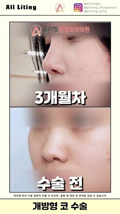 All Liting @alllitingps @allliting_liftingcenter @allliting_selfie 올리팅성형외과의원 3개월차 · 수술 전 개인에 따라 수술 결과가 다를 수 있으며, 출혈 및 염증 등 부작용 있을 수 있습니다 개방형 코 수술