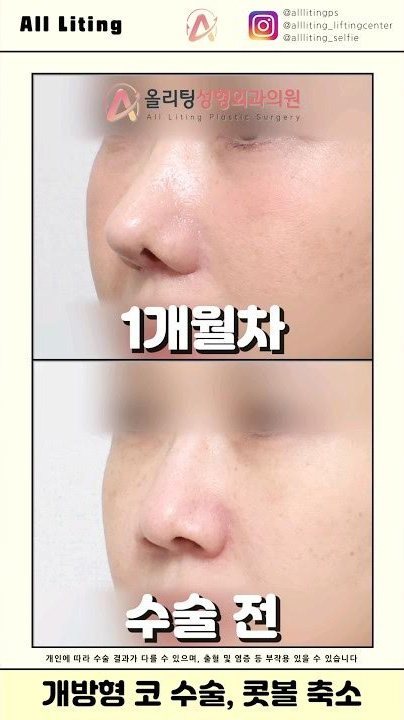 All Liting @alllitingps @allliting_liftingcenter @allliting_selfie 올리팅성형외과의원 1개월차 · 수술 전 개인에 따라 수술 결과가 다를 수 있으며, 출혈 및 염증 등 부작용 있을 수 있습니다 개방형 코 수술, 콧볼 축소