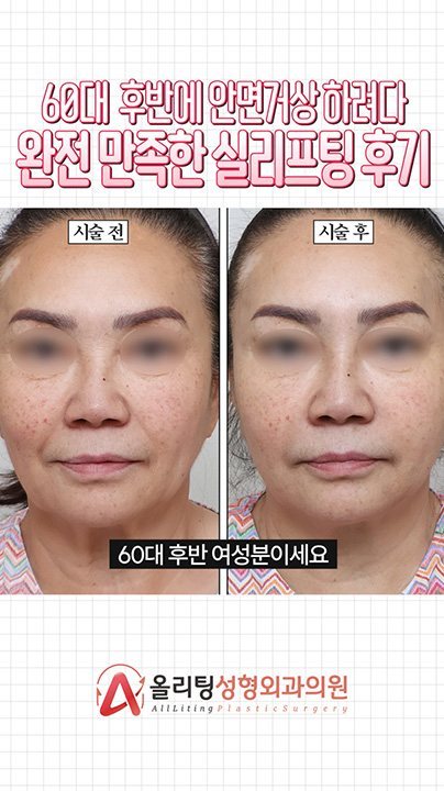 60대 후반에 안면거상 하려다 완전 만족한 실리프팅 후기 시술 전 · 시술 후 60대 후반 여성분이세요 올리팅성형외과의원