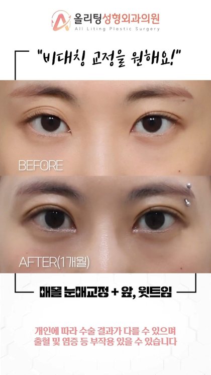 올리팅성형외과의원 "비대칭 교정을 원해요!" BEFORE · AFTER(1개월) 매몰 눈매교정 + 앞, 윗트임 개인에 따라 수술 결과가 다를 수 있으며 출혈 및 염증 등 부작용 있을 수 있습니다