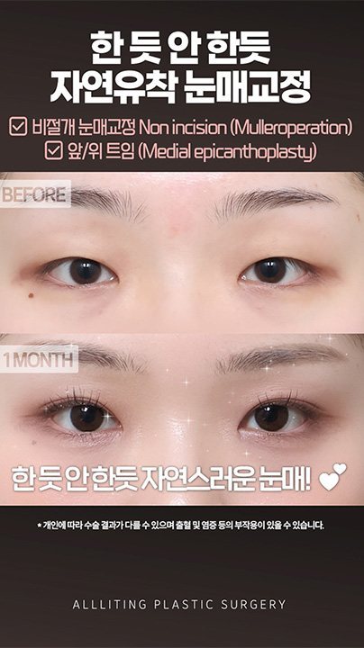 한 듯 안 한듯 자연유착 눈매교정 ☑ 비절개 눈매교정 Non incision (Mulleroperation) ☑ 앞/위 트임 (Medial epicanthoplasty) BEFORE · 1MONTH 한 듯 안 한듯 자연스러운 눈매! * 개인에 따라 수술 결과가 다를 수 있으며 출혈 및 염증 등의 부작용이 있을 수 있습니다. ALLLITING PLASTIC SURGERY