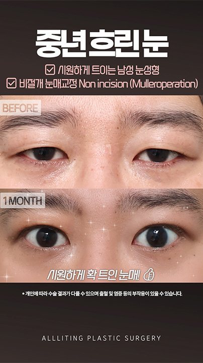 중년 흐린눈 ☑ 시원하게 트이는 남성 눈성형 ☑ 비절개 눈매교정 Non incision (Mulleroperation) BEFORE · 1MONTH 시원하게 확 트인 눈매! * 개인에 따라 수술 결과가 다를 수 있으며 출혈 및 염증 등의 부작용이 있을 수 있습니다. ALLLITING PLASTIC SURGERY
