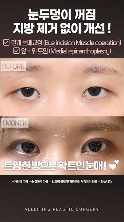 눈두덩이 꺼짐 지방 제거 없이 개선 ! ☑ 절개 눈매교정 (Eye incision Muscle operation) ☑ 앞 + 위 트임 (Medial epicanthoplasty) BEFORE · 1MONTH 트임한방으로확트인눈매! * 개인에 따라 수술 결과가 다를 수 있으며 출혈 및 염증 등의 부작용이 있을 수 있습니다. ALLLITING PLASTIC SURGERY