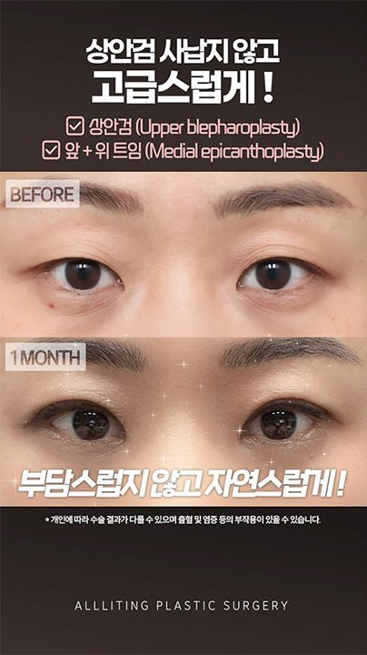 상안검 사납지 않고 고급스럽게 ! ☑ 상안검 (Upper blepharoplasty) ☑ 앞 + 위 트임 (Medial epicanthoplasty) BEFORE · 1MONTH 부담스럽지 않고 자연스럽게! * 개인에 따라 수술 결과가 다를 수 있으며 출혈 및 염증 등의 부작용이 있을 수 있습니다. ALLLITING PLASTIC SURGERY