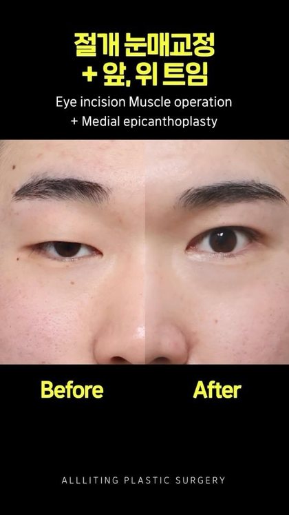 절개 눈매교정 + 앞, 위 트임 Eye incision Muscle operation + Medial epicanthoplasty Before · After ALLLITING PLASTIC SURGERY