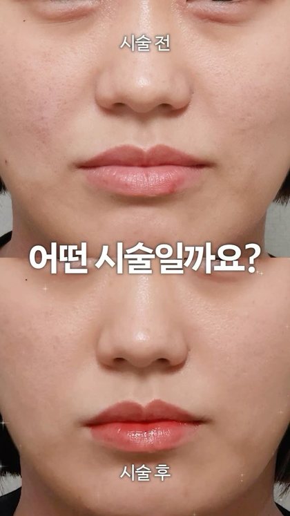 시술 전 어떤 시술일까요? 시술 후