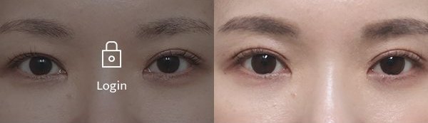 매몰눈재수술눈매교정 전후사진
