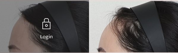 이마지방이식재수술 전후사진