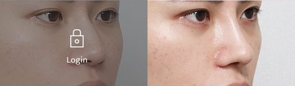 매부리코코성형술+콧대코끝이물질제거 전후사진