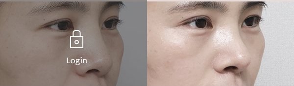 무보형물코끝성형술 전후사진