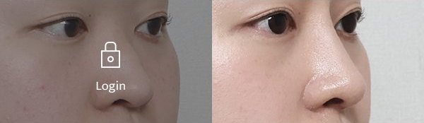미니자가늑 매부리코 코성형술 전후사진