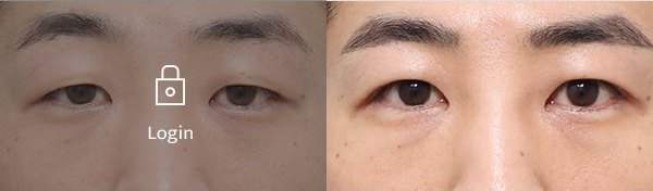 절개무쌍눈매교정 전후사진