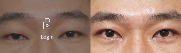 남자절개눈매교정 전후사진