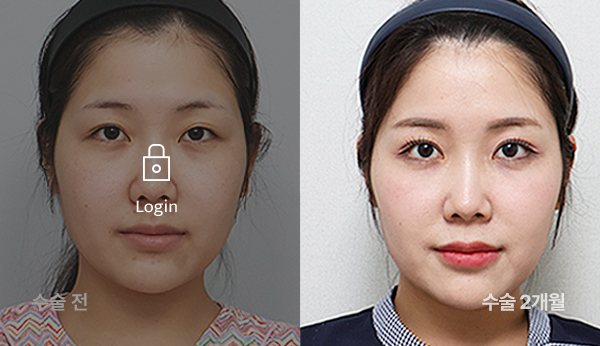 매몰쌍꺼풀+눈밑지방재배치+입술필러 전후사진