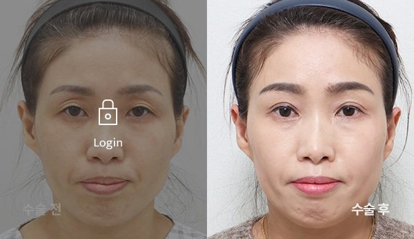 상안검수술+눈매교정재수술(눈 재수술, 앞트임, 위트임)+눈두덩이지방이식+엔도타인내시경이마거상 전후사진