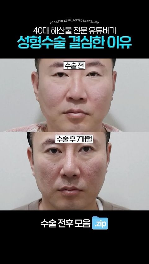 눈코성형